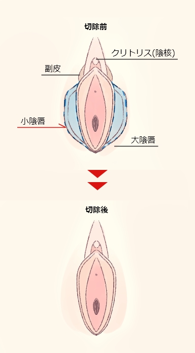 小陰唇切除前と後