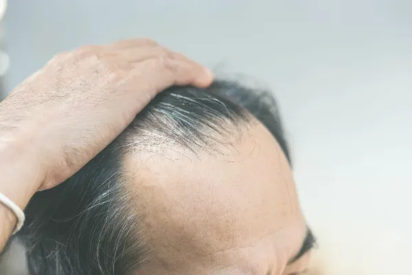 植毛と人工知能：AIがもたらす技術革新