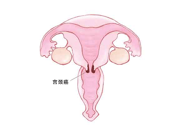 子宮頸がんとは
