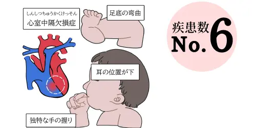 爱德华兹综合症